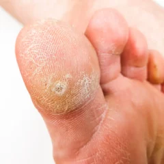 cor au pied