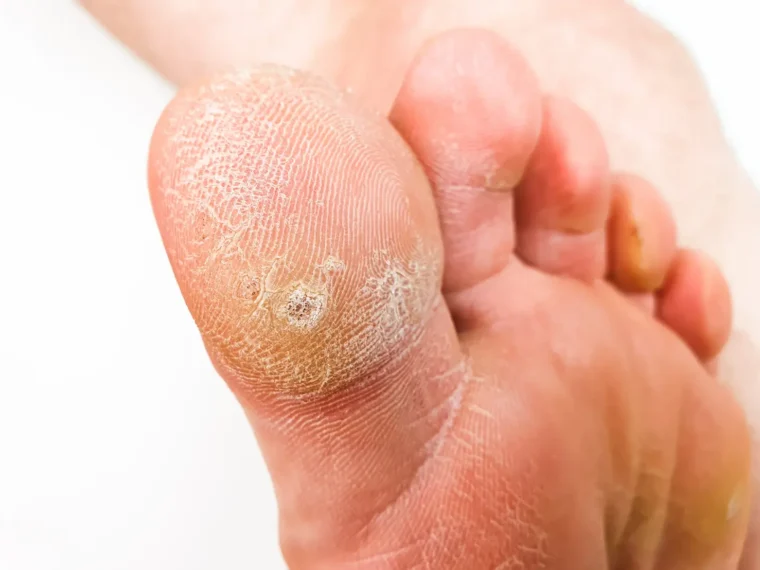 cor au pied