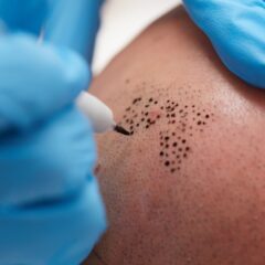 tricopigmentation