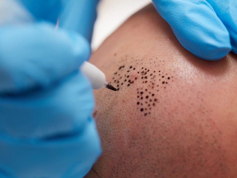 tricopigmentation